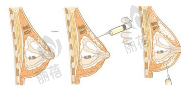 广州艺星医疗美容医院蒋思军做自体脂肪隆胸技术有哪些特点？