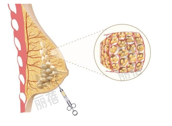 广州艺星医疗美容医院自体脂肪隆胸手术多少钱？