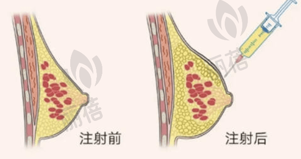 广州军美医疗美容医院王世虎自体脂肪隆胸怎么样？