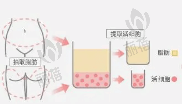 广州军美医疗美容医院王世虎自体脂肪隆胸优势汇总