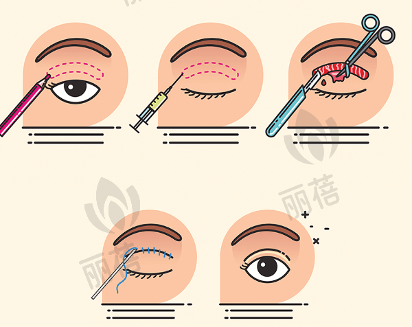沈国雄做双眼皮修复技术特点