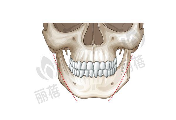 广州广大整形何锦泉做下颌角采用3D导板技术优势