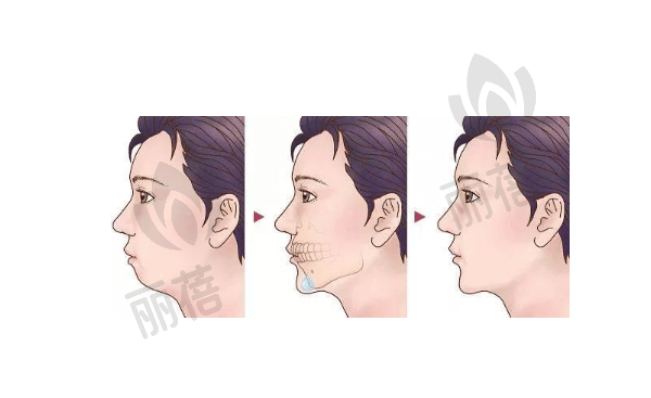 广州广大整形医院下颌角整形40000元起