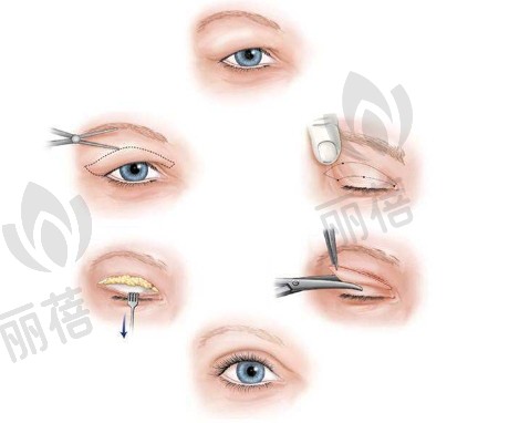 双眼皮的类型有哪些?双眼皮手术是怎么做的