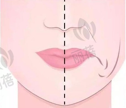 鼻基底填充可以改良鼻唇沟吗