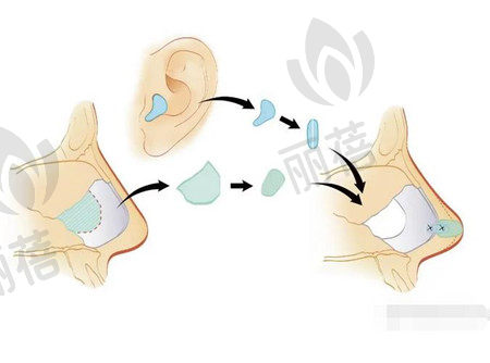 耳软骨垫鼻尖手术适合哪些人？手术后会受到撞击影响吗？