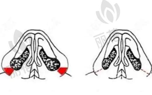 鼻翼内切留下的疤痕如何处理