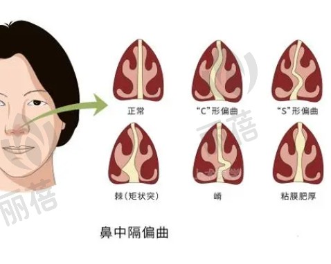 鼻中隔偏曲有哪些症状，是否需要手术?