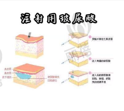 玻尿酸丰唇珠有哪些优点，可以维持多久