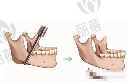 颧骨提升手术费用高吗?要多少钱