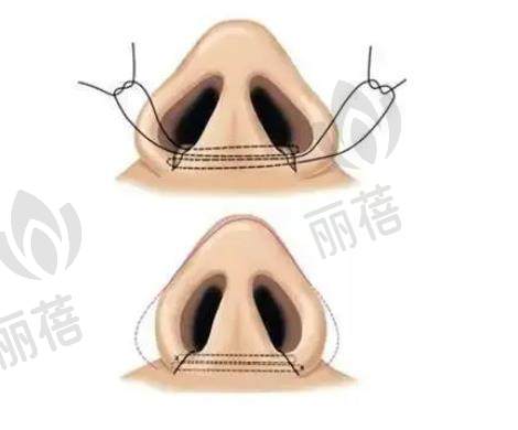 鼻翼缩小术有哪些后遗症?如何避免