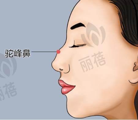 驼峰鼻矫正恢复时间受哪些因素影响