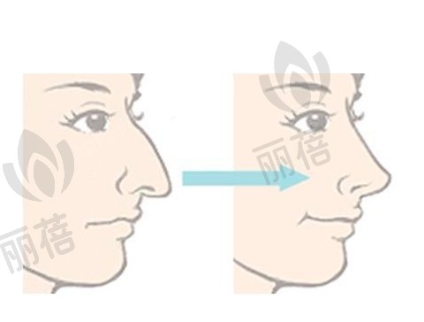 鹰钩鼻矫正效果及价格的影响因素