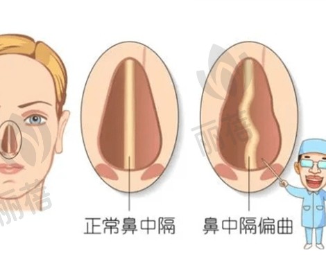 有哪些矫正歪鼻的方法