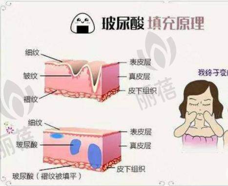 玻尿酸可以直接涂脸吗，有用吗