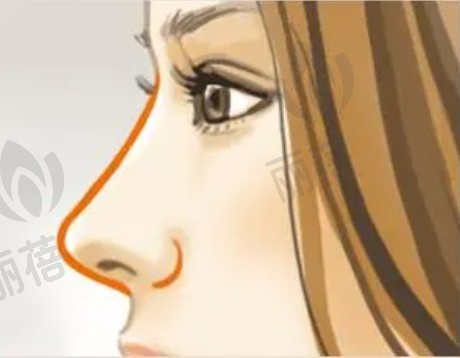 鼻部整形修复需要更换假体吗，步骤有哪些