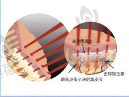 蜂巢皮秒激光的副作用可能有哪些?