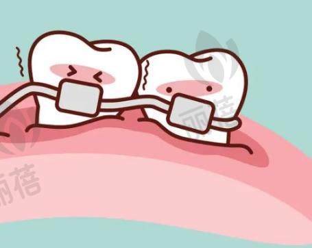 矫正牙齿的方法有哪些?