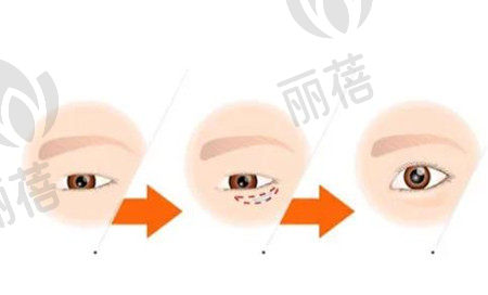 去眼袋手术后出现增生怎么办?