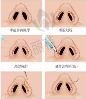 鼻翼外切除术和鼻翼内切除术哪个更好?