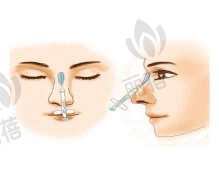 玻尿酸隆鼻有哪些优势和缺点