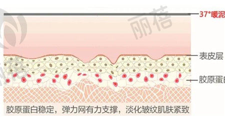 做热玛吉怎么样?哪些人适合