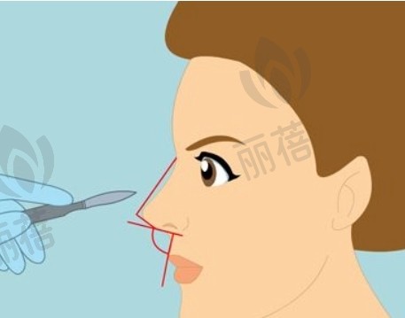 假体隆鼻的效果是否可以永久维持?