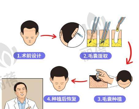 植发后毛囊受损怎么办?哪个季节适合植发