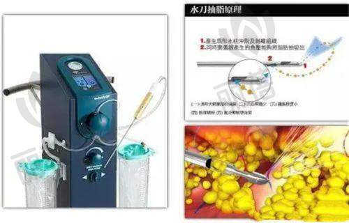 植发技术