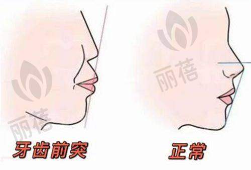 双11正畸优惠
